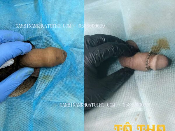 Cắt Bao Quy Đầu: Tăng Kích Thước, Cải Thiện Chức Năng Năng Sinh Lý và Đòi Ngừa Bệnh Tật